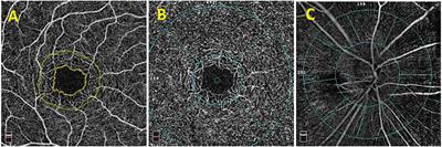 Analysis of Microcirculation Changes in the Macular Area and Para-Optic Disk Region After Implantable Collamer Lens Implantation in Patients With High Myopia